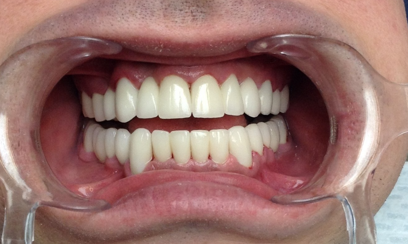 Zircomium Crowns Before After