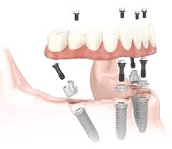 All-On-4 implants london