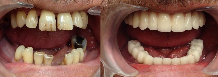 All on four dental implant before after