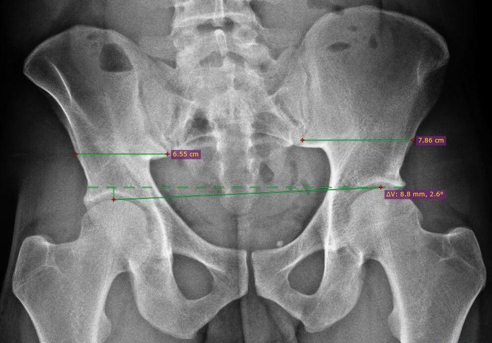 An x-ray of a person 's pelvis with measurements on it.