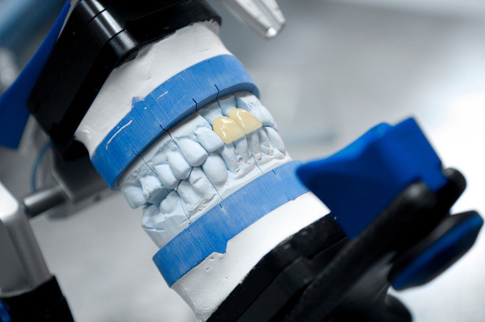 Zirkonoxid Frontzähne im Dentallabor Frankfurt