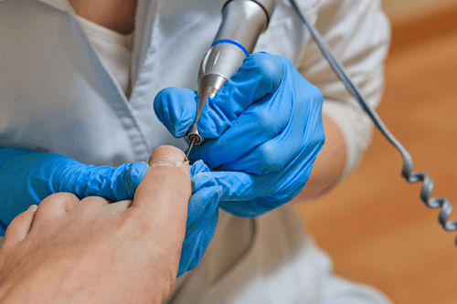 Ingrown Nails West Seneca, NY