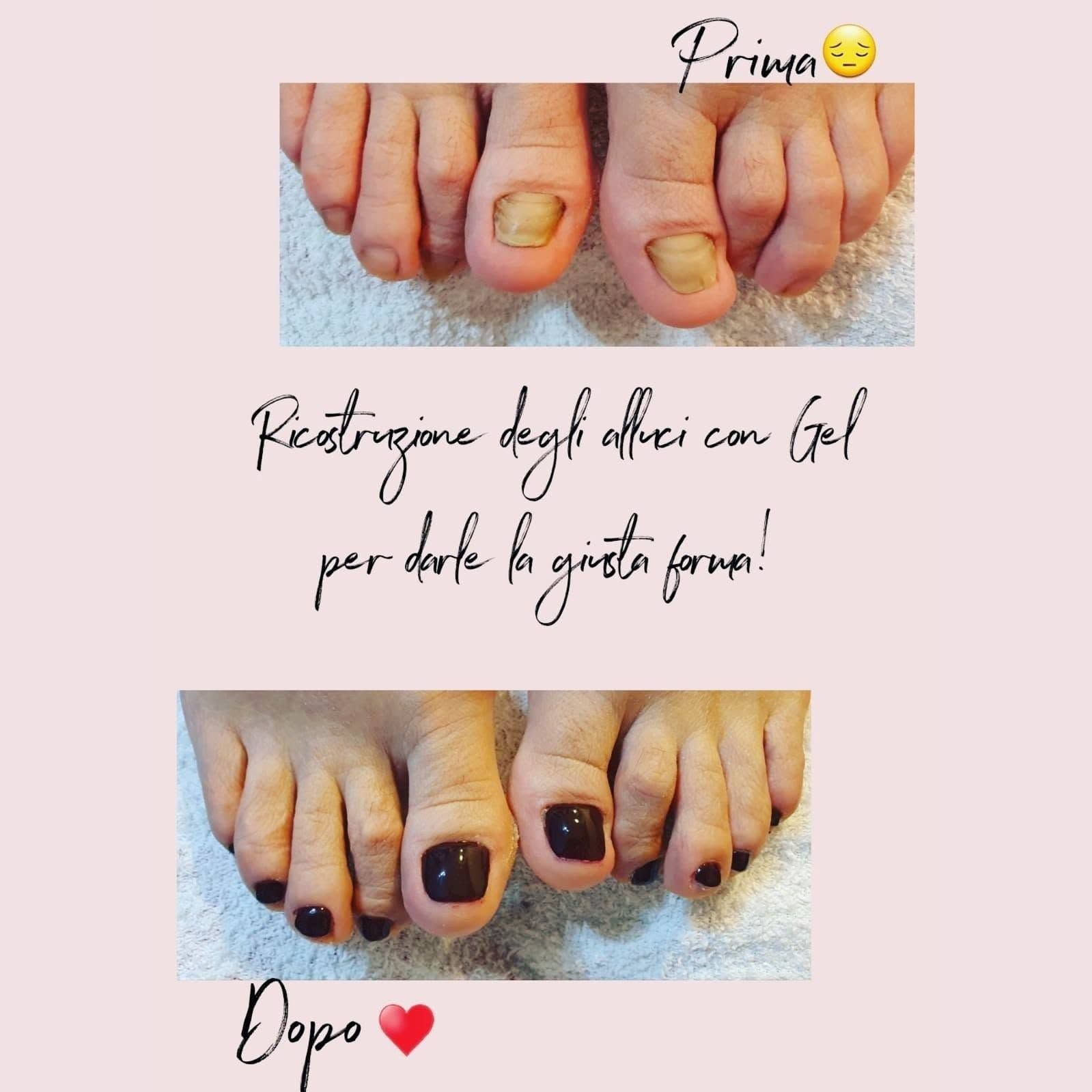 Primo piano di piedi con unghie scure prima e dopo; in alto si vedono le unghie ingiallite, in basso lo smalto nero.