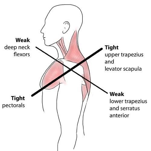 A diagram of a person 's neck and shoulder muscles.
