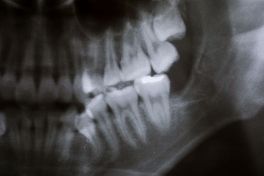 X-ray of Teeth and Jaw, Showing Wisdom Teeth and Other Molars — Trinity Beach Dental In Trinity Beach, QLD