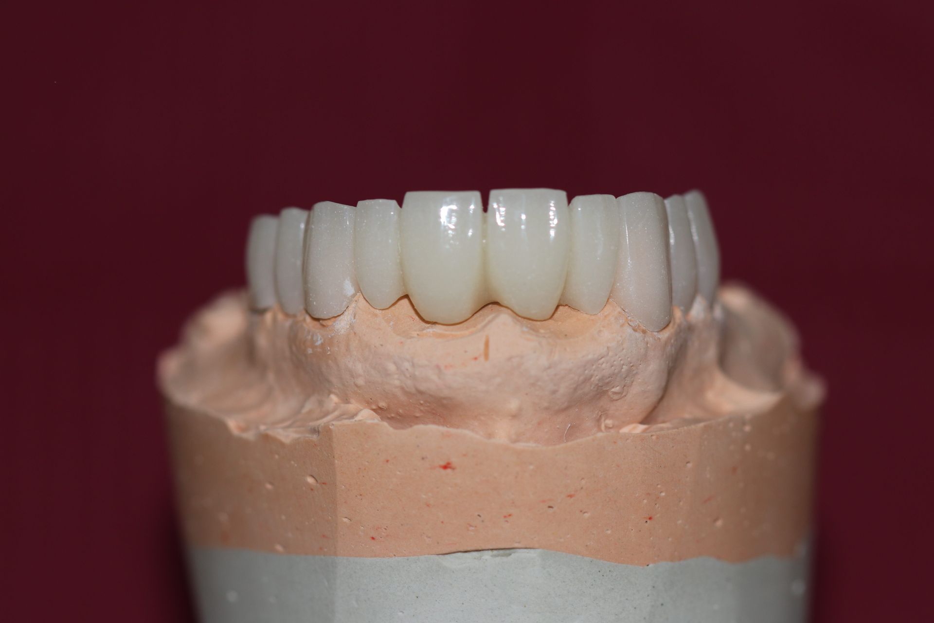 Dental Model With a Row of Upper Front Teeth in a Lab Setting — Trinity Beach Dental In Trinity Beach, QLD