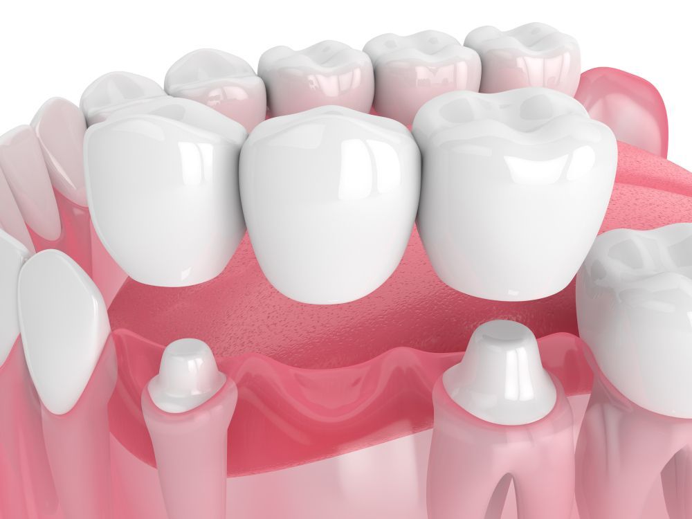 Dental Bridge, a Prosthetic Dental Device, Spans a Tooth Gap — Trinity Beach Dental In Trinity Beach, QLD