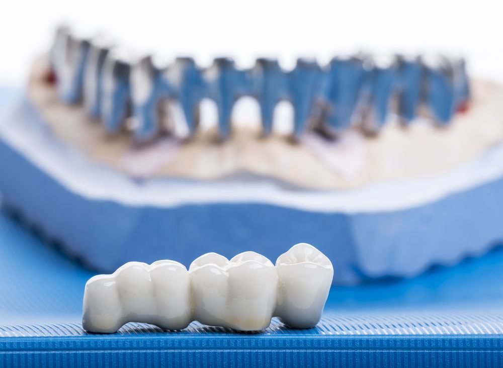Dental Bridge, White Ceramic, on Blue Surface — Trinity Beach Dental In Trinity Beach, QLD