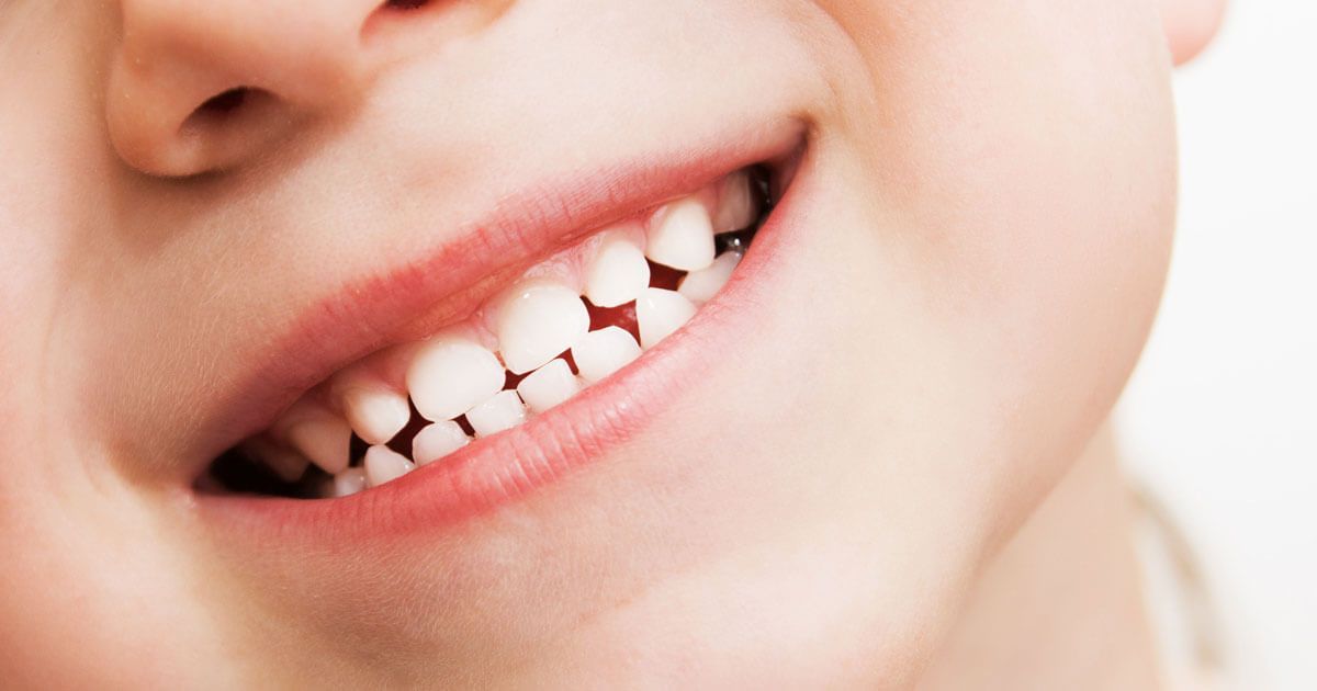 Close-up of a Smiling Mouth With a Missing Front Tooth — Trinity Beach Dental In Trinity Beach, QLD