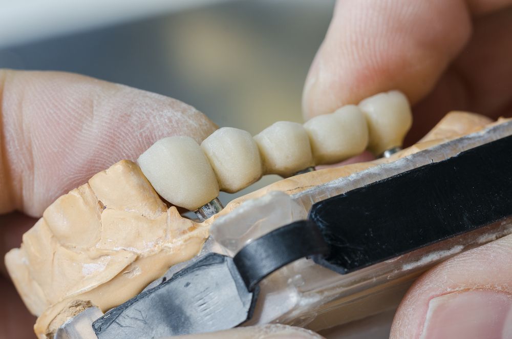 Hands Holding a Dental Bridge Over a Plaster Dental Model — Trinity Beach Dental In Trinity Beach, QLD