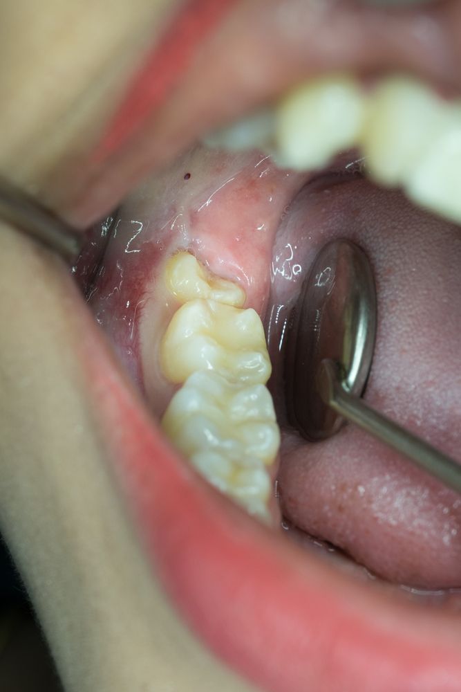 Mouth Interior, Showing a Molar With a Dental Mirror, and Swollen Gum — Trinity Beach Dental In Trinity Beach, QLD