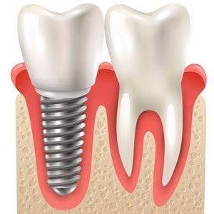 Diagram of a Tooth Implant Next to a Natural Tooth — Trinity Beach Dental In Trinity Beach, QLD