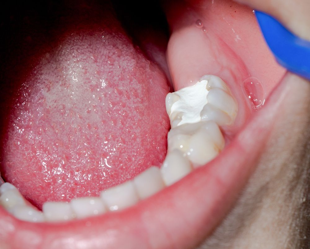 Mouth Open, Showing a Molar With a White Filling, Tongue Visible on the Left — Trinity Beach Dental In Trinity Beach, QLD
