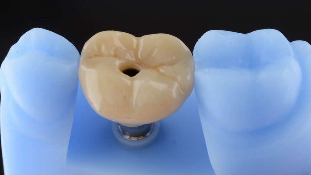 Dental Crown Model, Tan With Dark Hole, Between Two Light — Trinity Beach Dental In Trinity Beach, QLD