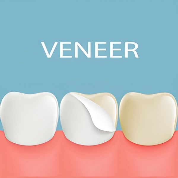 Illustration Showing a Tooth With a Veneer Being Applied — Trinity Beach Dental In Trinity Beach, QLD