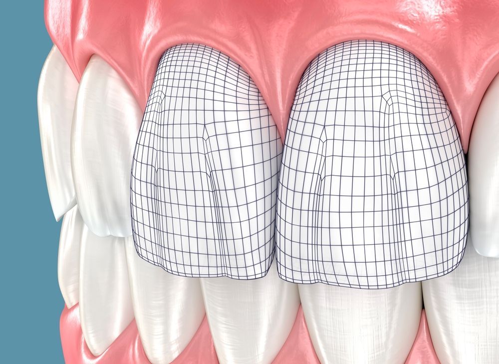 Diagram of Teeth With Wireframe Overlays — Trinity Beach Dental In Trinity Beach, QLD