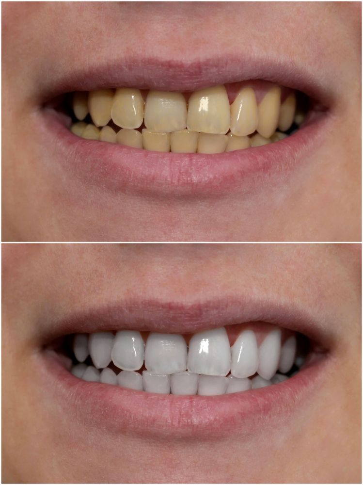 Side-by-side Comparison of Teeth. Top Row Shows Yellowed Teeth — Trinity Beach Dental In Trinity Beach, QLD