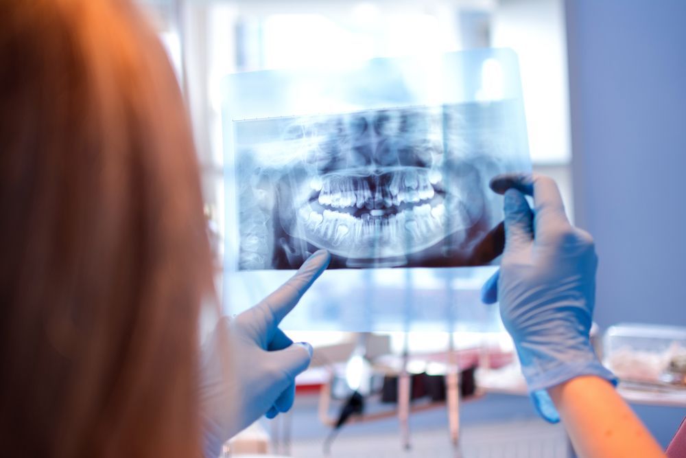Dentist in Blue Gloves Examining Dental X-ray, Pointing at the Teeth — Trinity Beach Dental In Trinity Beach, QLD