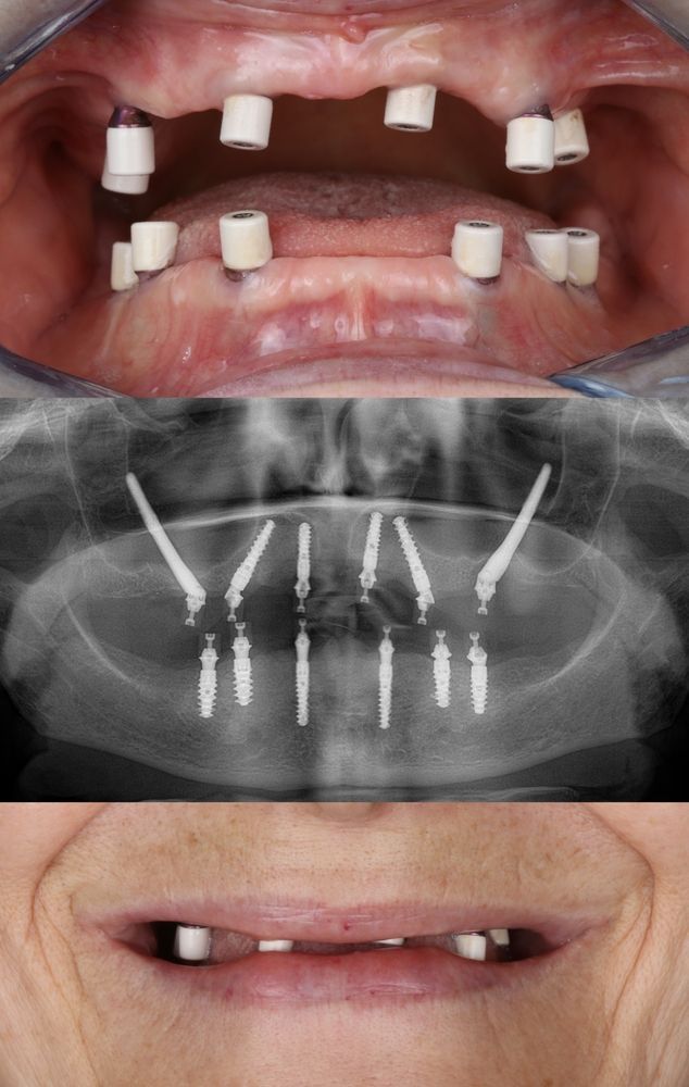 Top: Dental Implants in Mouth. Middle: Panoramic X-ray of Implants — Trinity Beach Dental In Trinity Beach, QLD