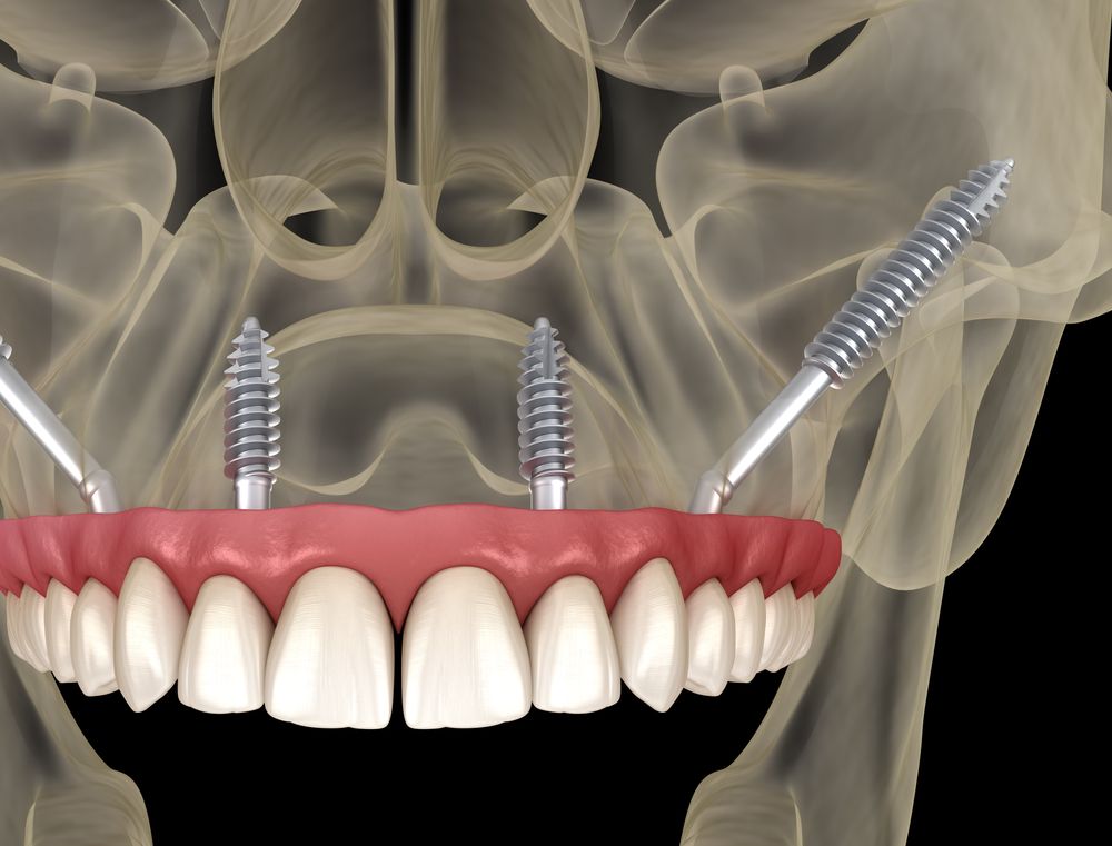 Dental Implant Procedure Illustration — Trinity Beach Dental In Trinity Beach, QLD