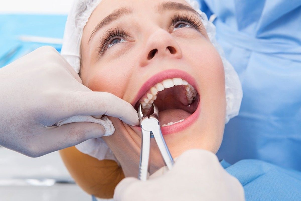 Wisdom Tooth Removed