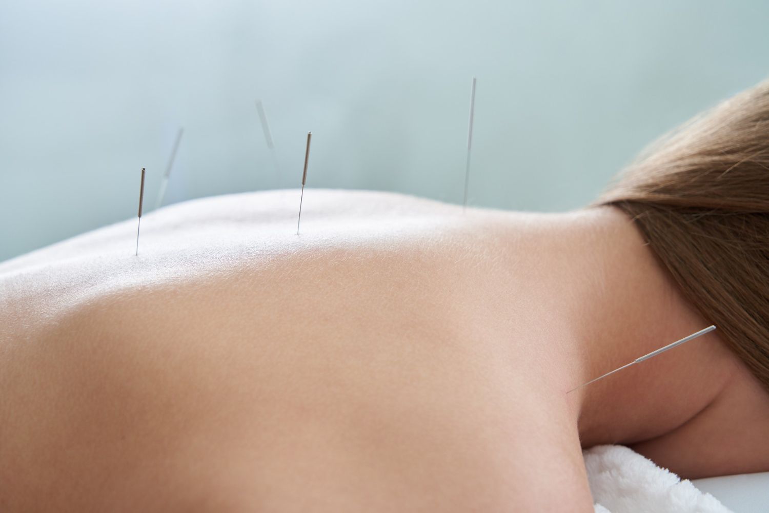 A person lying down receiving acupuncture treatment with thin needles inserted along their back and neck.