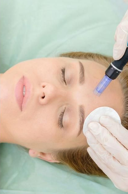 A practitioner in gloves uses a microneedling device on a person’s forehead, while holding a cotton pad.