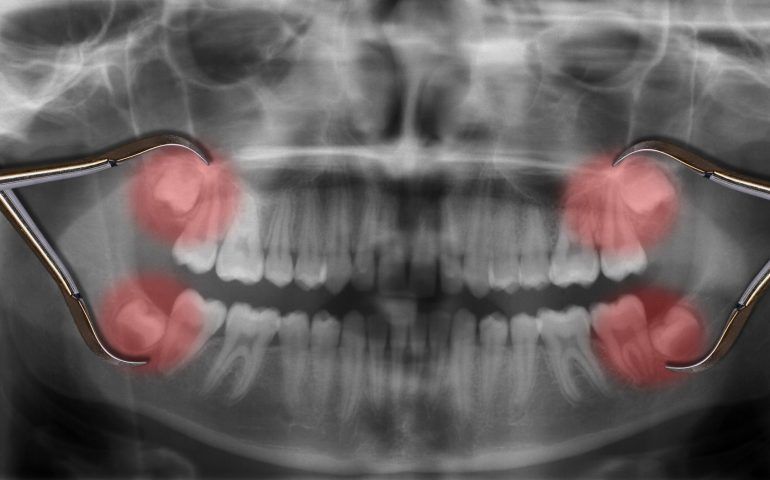 Impacted Tooth Impacted Tooth