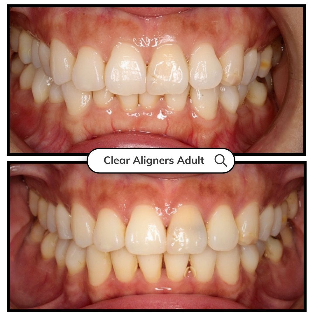 Before and after close-up of teeth alignment, with straighter teeth in the lower image.
