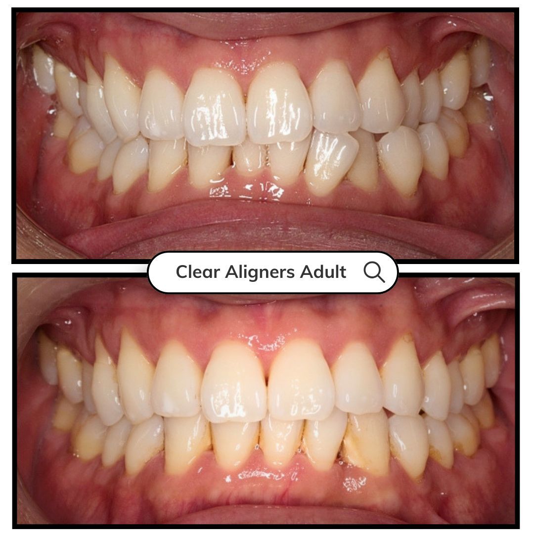 Before-and-after close-up of teeth alignment, with a “Clear Aligners Adult” label between images