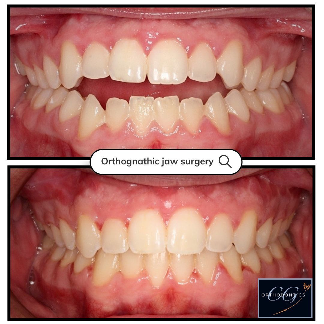Before-and-after close-up of teeth alignment, showing orthodontic jaw surgery results.