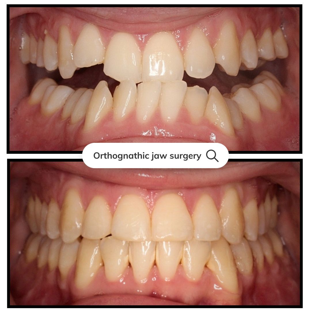 Before-and-after close-up of teeth alignment after orthognathic jaw surgery