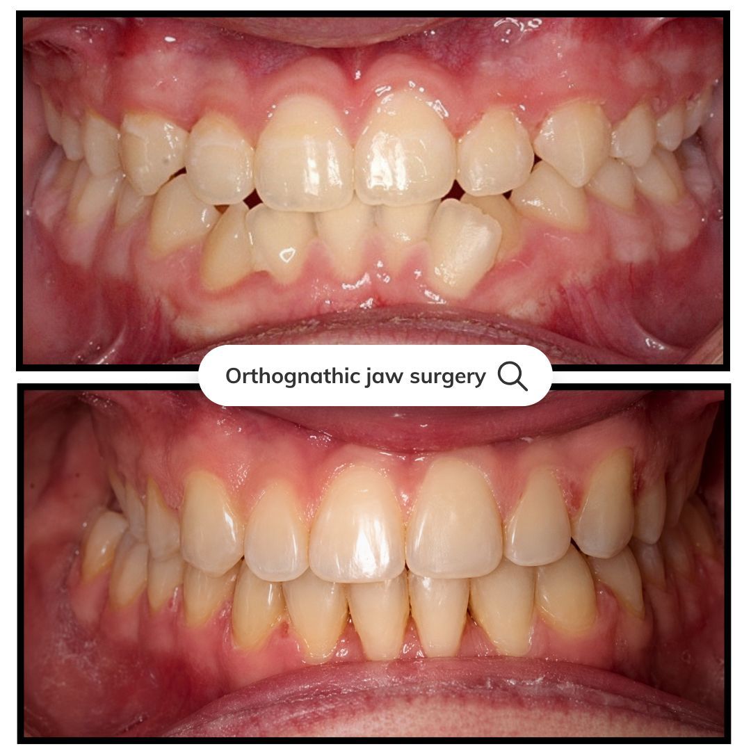 Top: crowded teeth before surgery; bottom: straighter teeth after orthognathic jaw surgery.