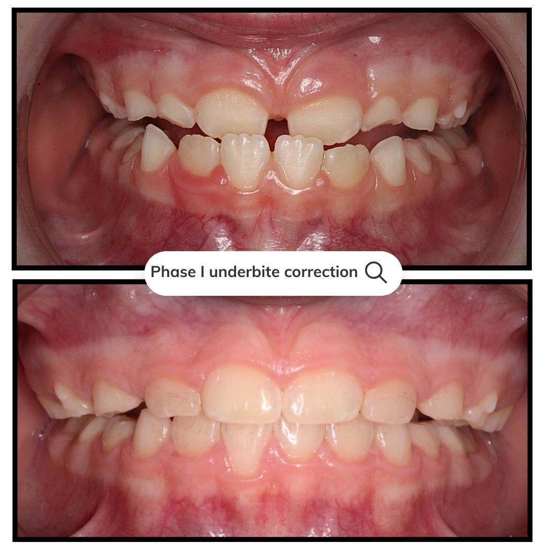 Two close-up dental photos showing before and after underbite correction.