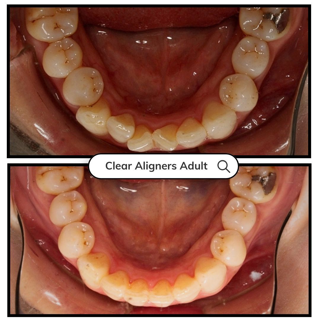 Two dental photos show the lower teeth before and after clear aligners treatment.