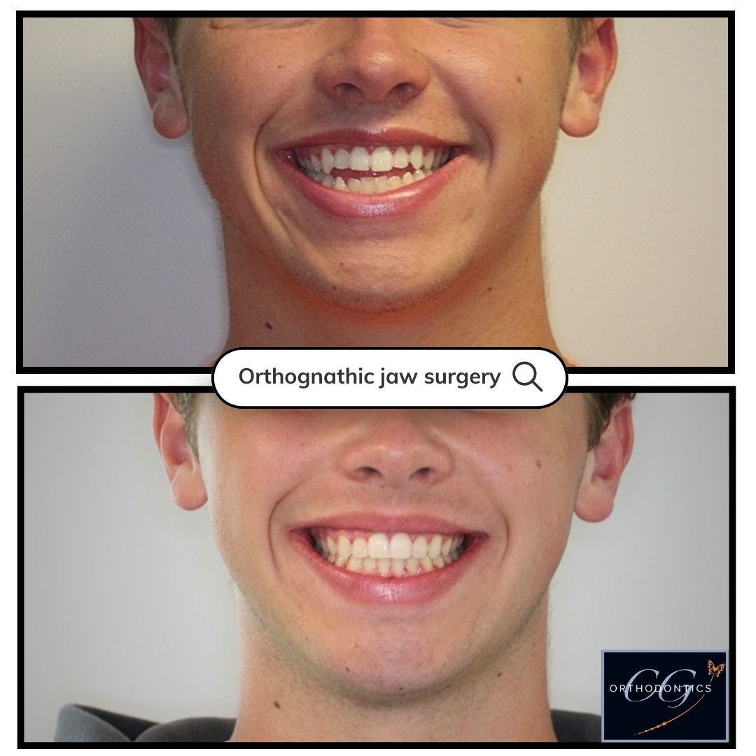 Before-and-after smile comparison showing teeth alignment after orthognathic jaw surgery