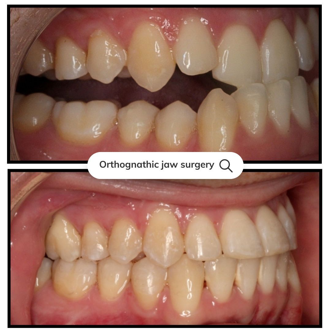 Before-and-after teeth photos showing orthodontic jaw surgery correcting an open bite