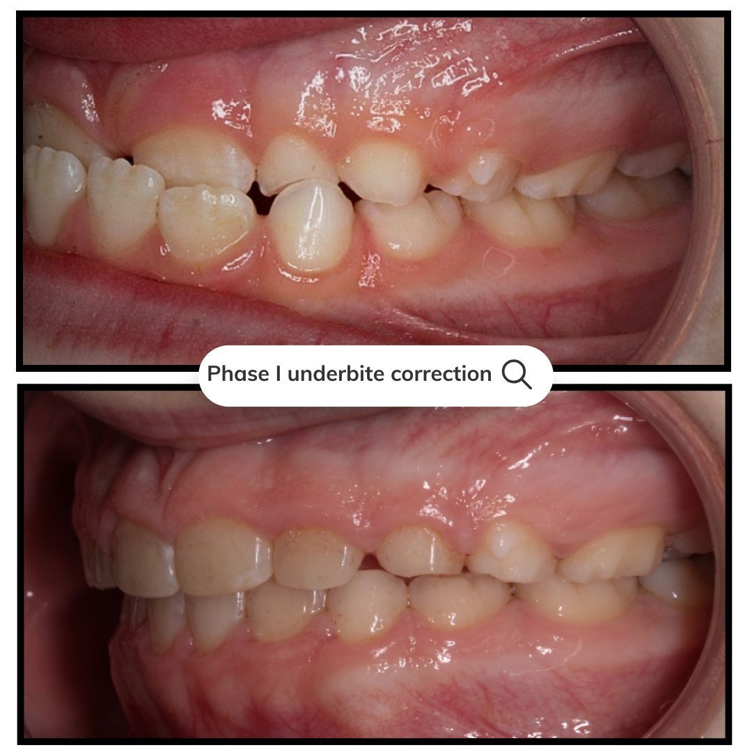Side-by-side orthodontic mouth photos showing teeth alignment before and after correction.