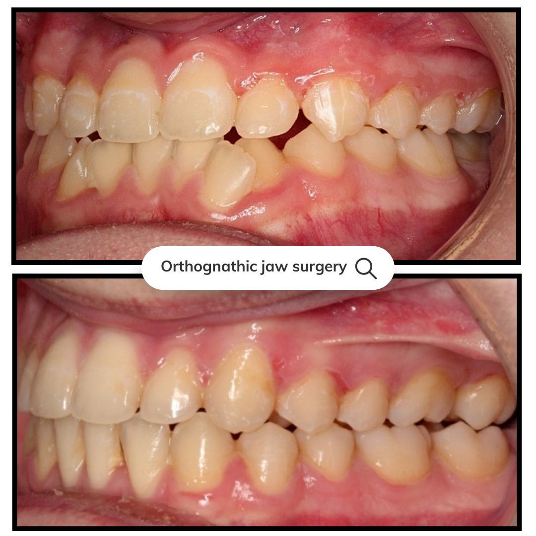 Side-by-side close-up of teeth before and after orthognathic jaw surgery