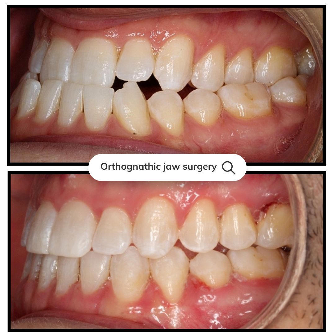 Before and after views of teeth, labeled