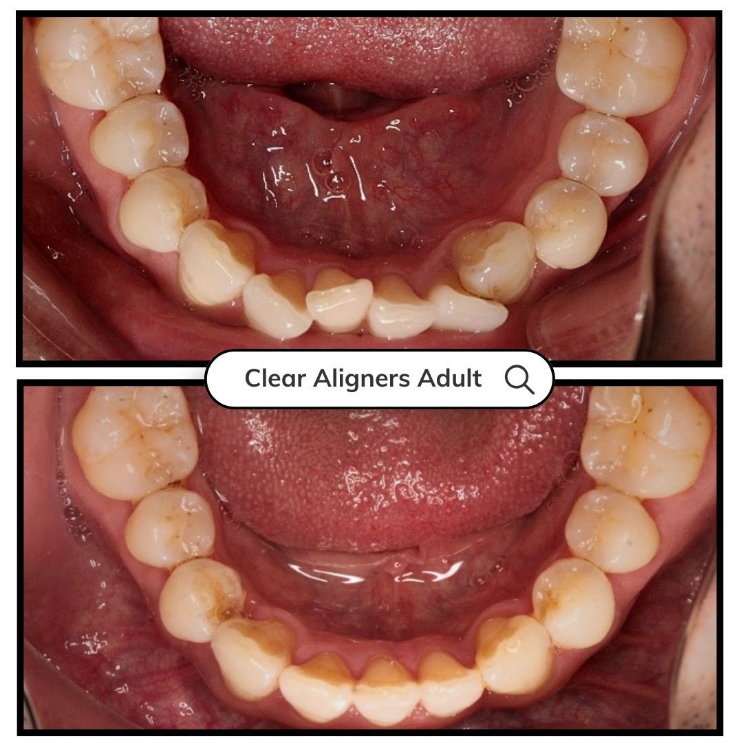 Two photos of the lower teeth before and after clear aligner treatment