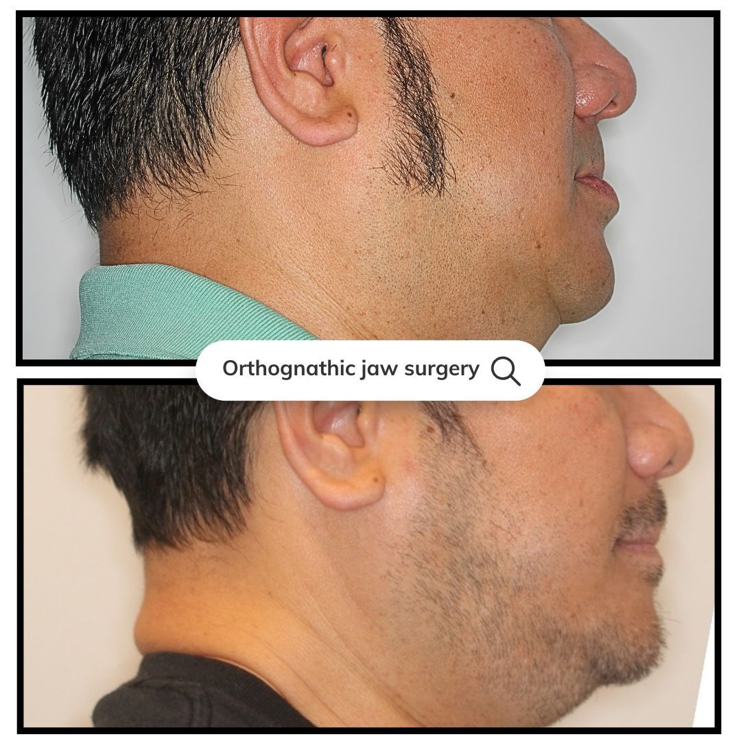 Comparison of a man's profile before and after orthognathic jaw surgery, showing changes to jaw and neck.