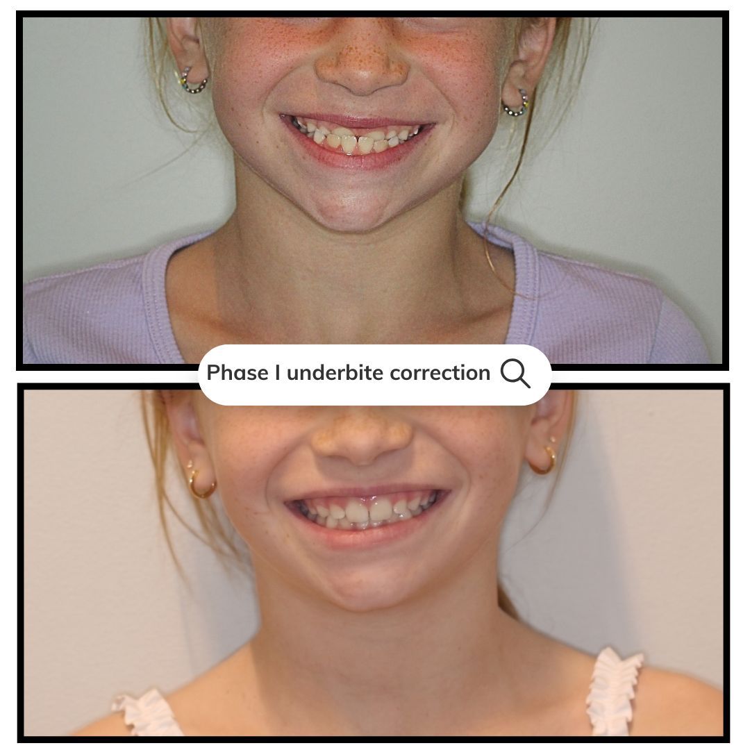 Before-and-after orthodontic correction showing a smiling child’s teeth before and after treatment