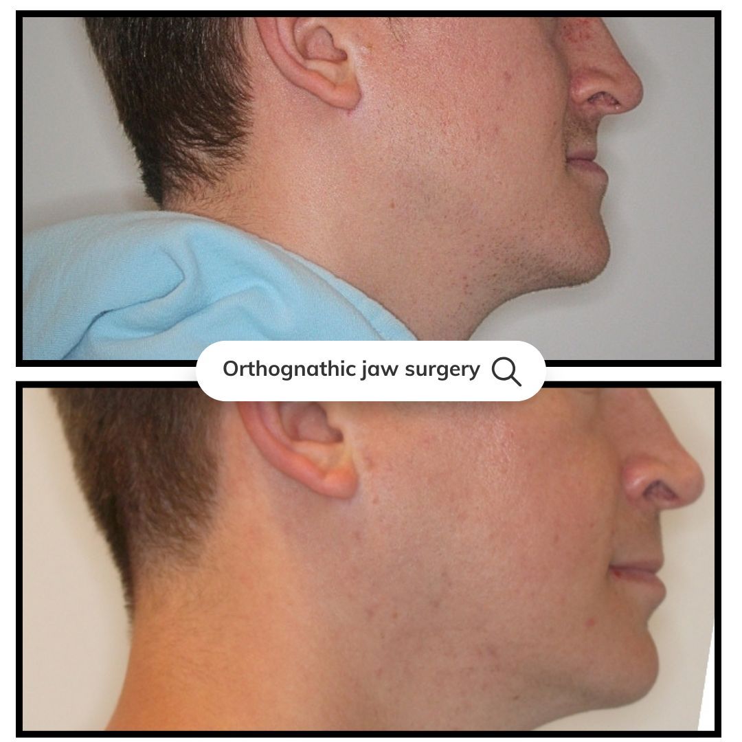 Side-by-side profile photos showing a jawline before and after orthognathic jaw surgery.