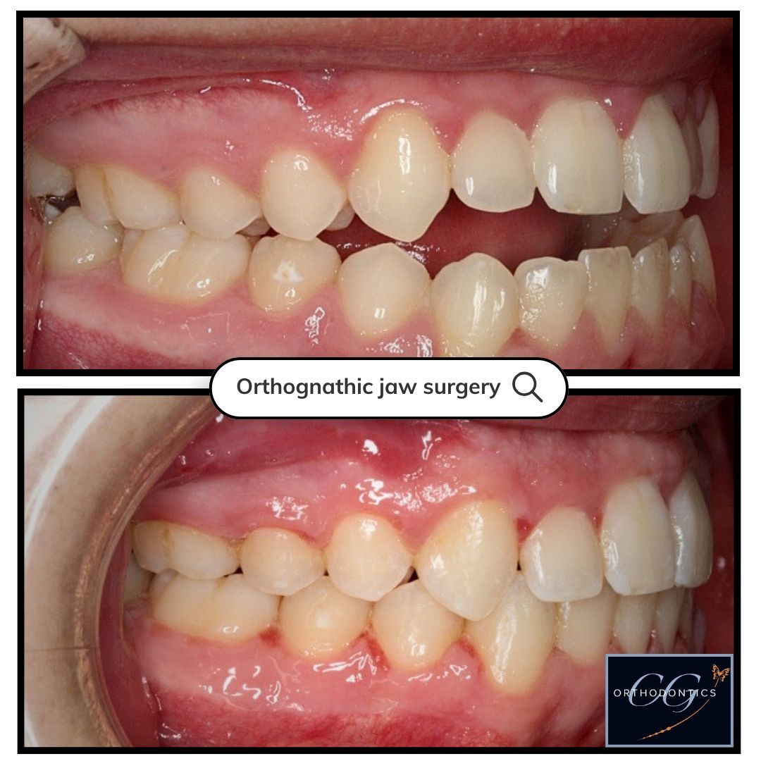 Before-and-after side view of teeth alignment, labeled “Orthognathic jaw surgery”