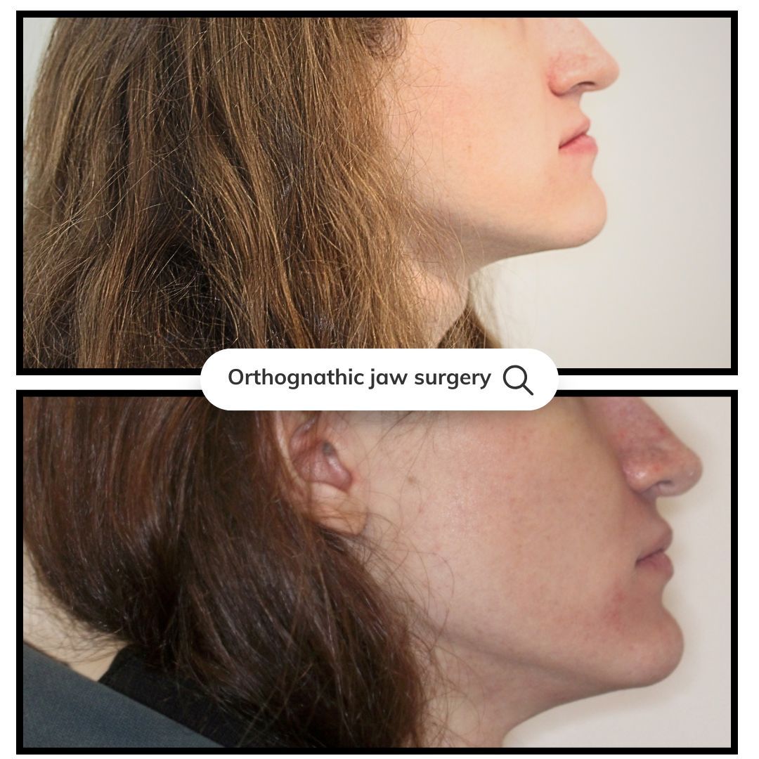 Side-by-side profile photos of a person's jawline before and after orthognathic jaw surgery.