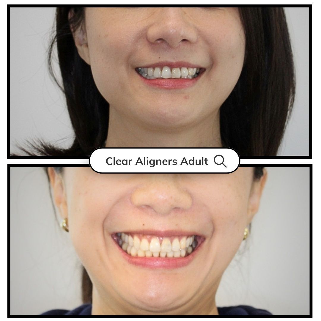 Before-and-after smile photos labeled “Clear Aligners Audit” with improved teeth alignment