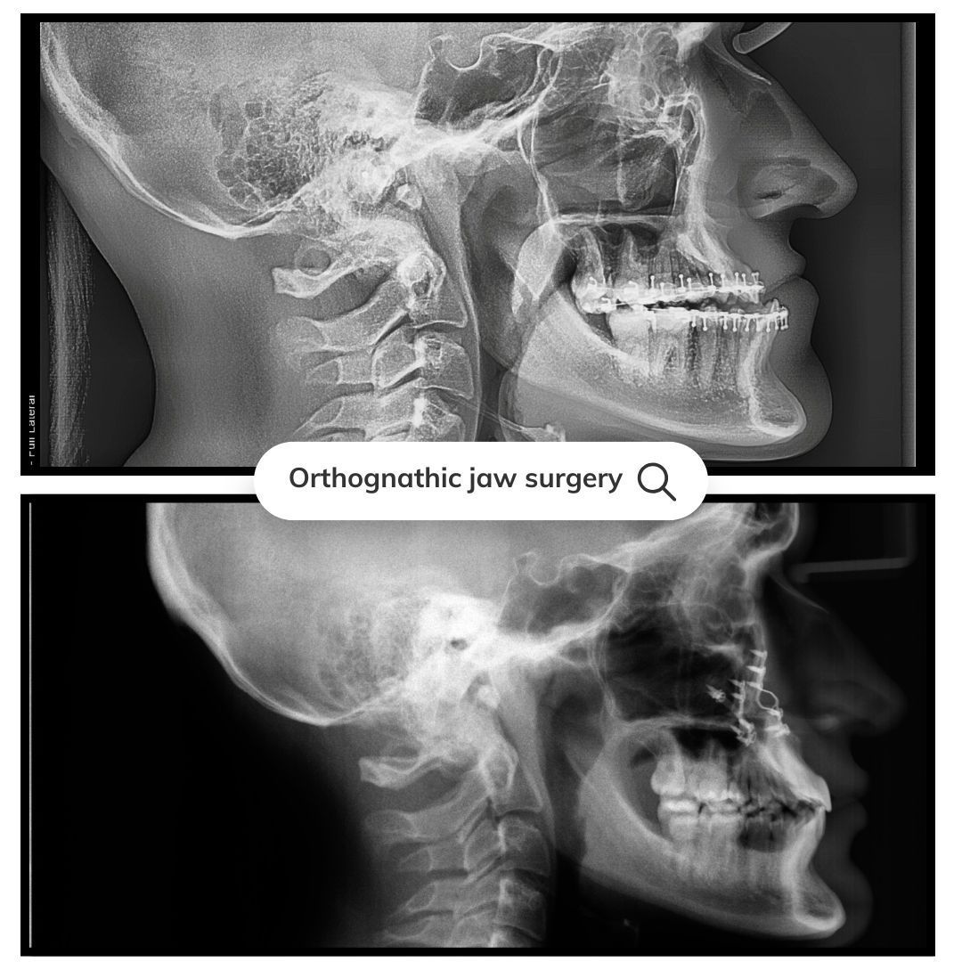 Side-view skull X-rays showing orthodontic jaw surgery comparison, before and after.