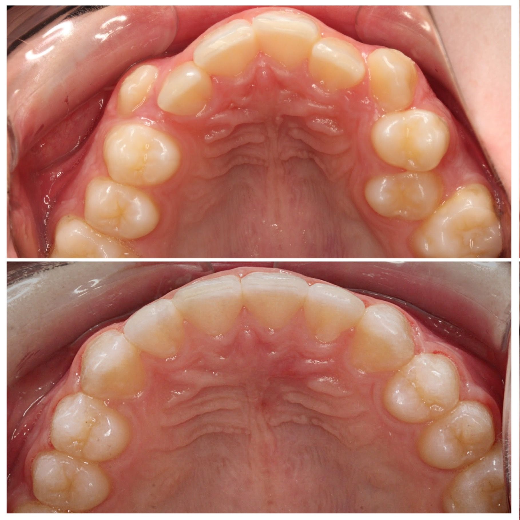 A before and after picture of a person 's teeth