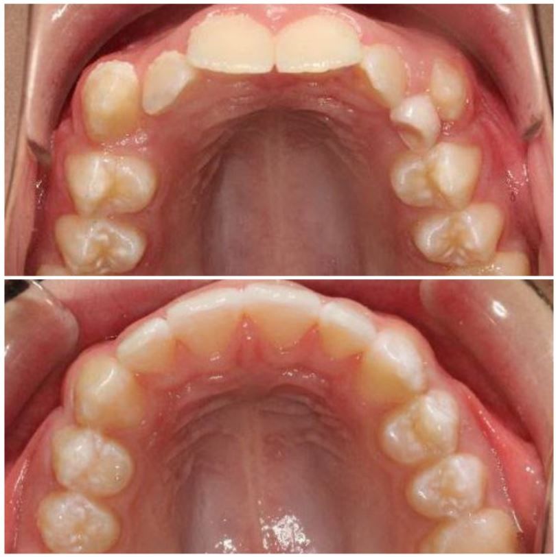 A before and after picture of a person 's teeth.